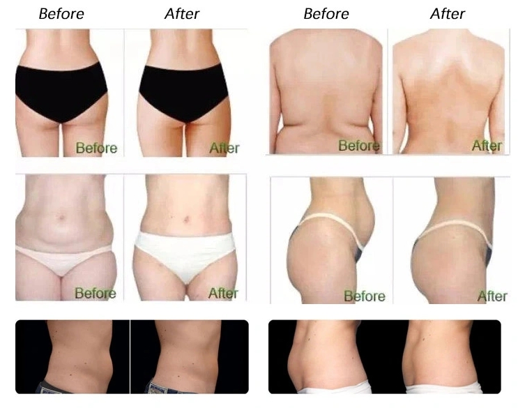 Before and after cryolipolysis treatment