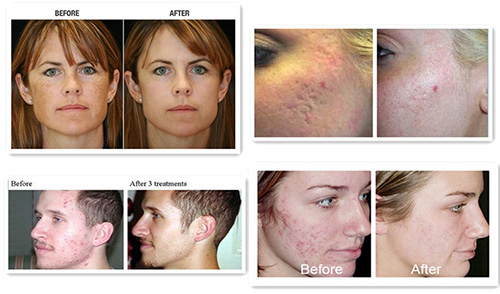 Before and after fractional CO2 laser skin treatment