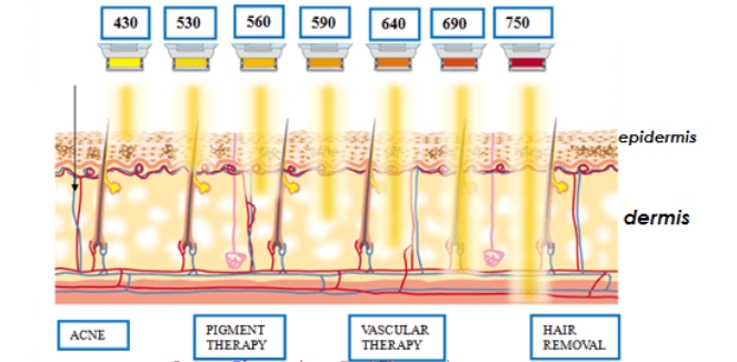 intense pulsed light photofacial-Wavelength