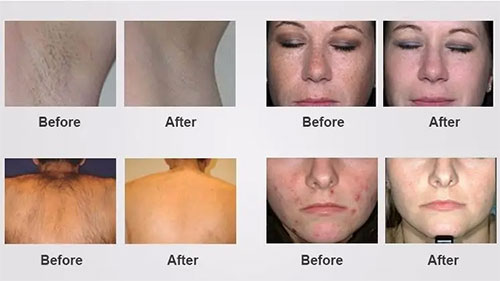 intense pulsed light therapy before and after