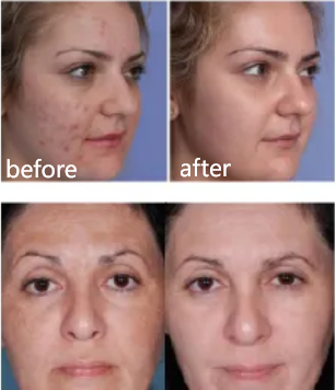 LED light phototherapy before and after