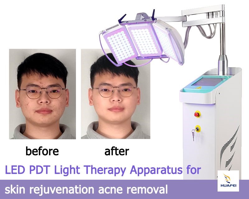 LED light therapy machine photon treatment acne before and after