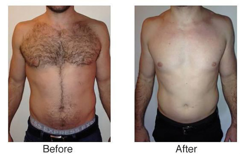 4 Wavelength Diode Laser Hair Removal Before and After