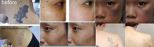 Nanosecond Q switch laser pigmentation treatment before and after