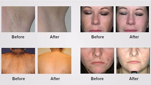SHR IPL laser hair removal before and after