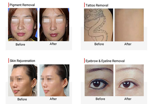 Pico laser before and after 1 treatment pigment and tattoo removal
