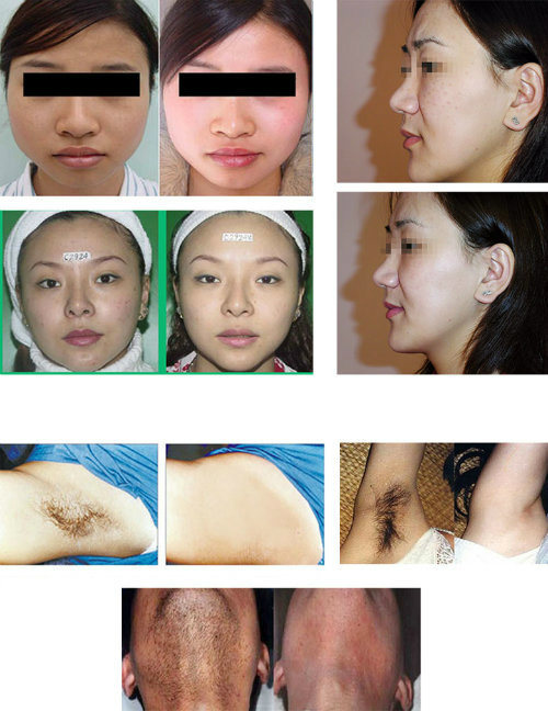 Before and after IPL laser facial treatment and hair removal