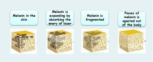 Q Switched ND Yag Laser to remove melanin