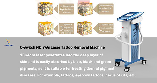 Q-Switched Nd:YAG Laser Tattoo Removal Machine