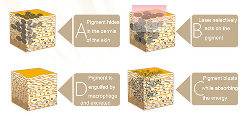Q-Switched Nd:YAG Laser Pigment Removal Process