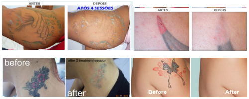 Q-Switched Nd:YAG Laser Tattoo Removal Before and After