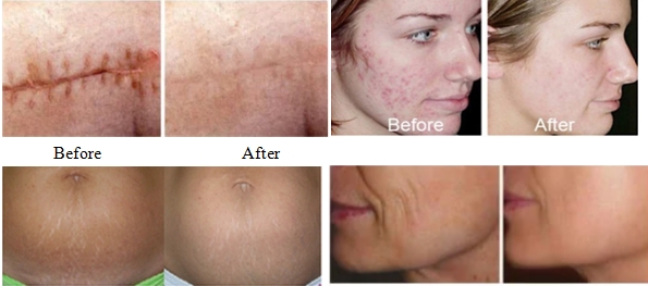 Before and after fractional CO2 laser treatment