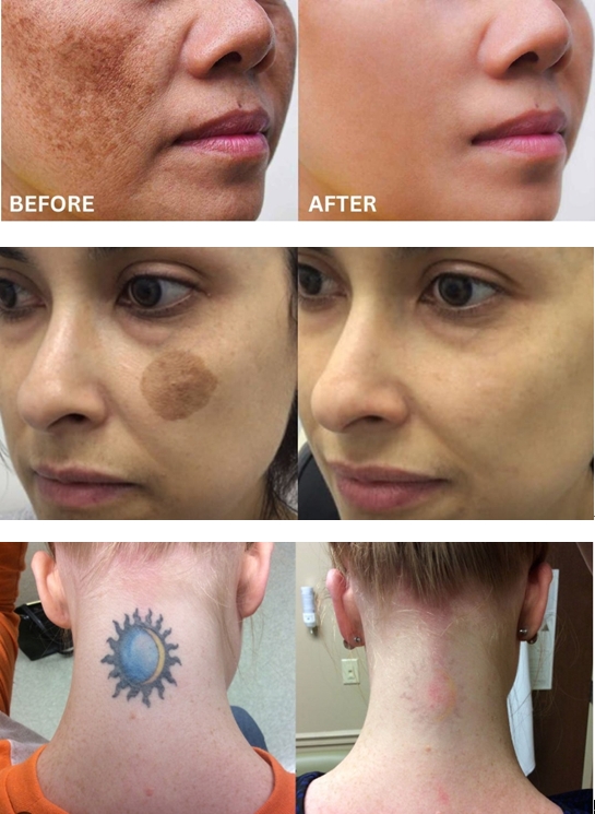 Q-Switch nd yag Laser before and after treatment