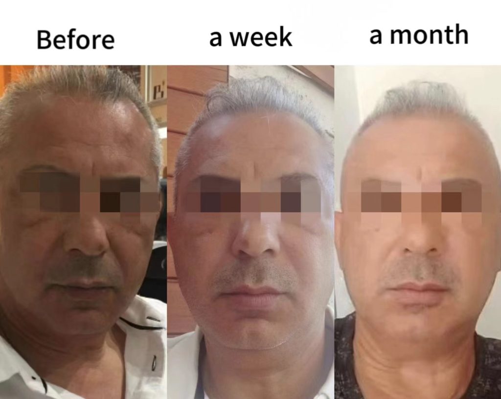 Thulium-laser-treatment-effect-picture