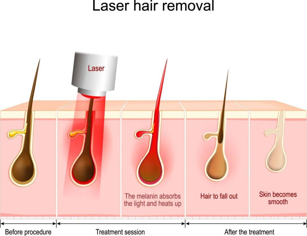 Laser Hair Removal Process Chart