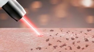 Bagan terperinci penghilangan partikel pigmen tato hitam dengan laser
