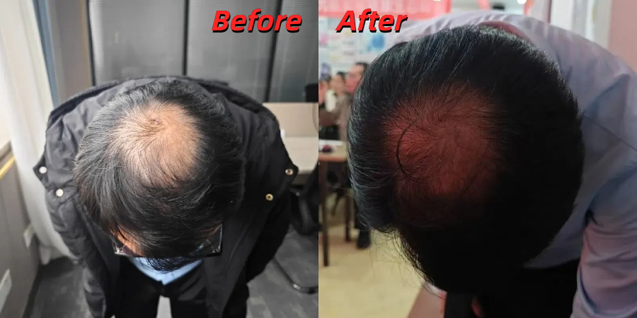 Red light hair growth before and after photos