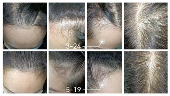 Thulium laser hair growth before and after