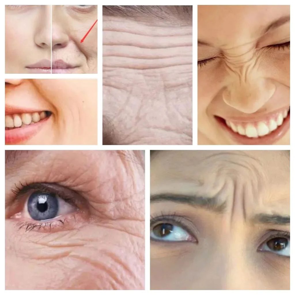 facial wrinkles photos