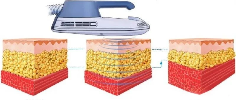 EMS Sculpt Machine reduces fat and increases muscle animation