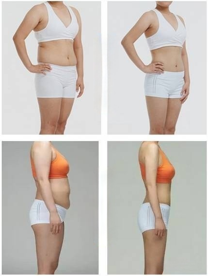 Fat cavitation treatment before and after picture