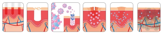 Thulium laser opens skin channels to better absorb products