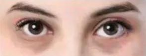 Blood vessel type dark circles
