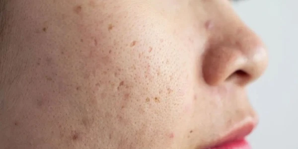 Real facial acne scar photos