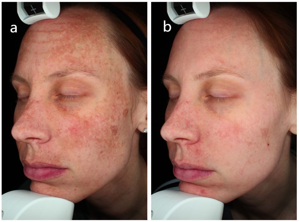 Perawatan melasma dengan laser panjang gelombang ganda 1550nm dan 1927nm sebelum dan sesudah