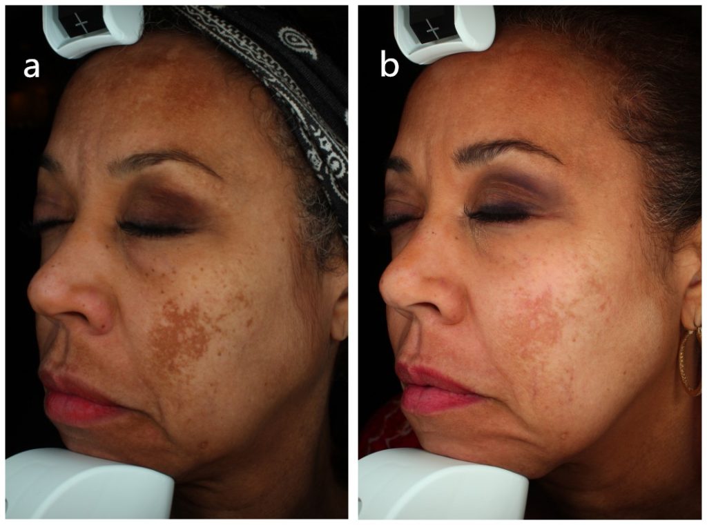 Perawatan melasma dengan laser panjang gelombang ganda 1550nm dan 1927nm sebelum dan sesudah satu bulan