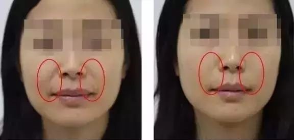 HIFU facial skin tightening before and after