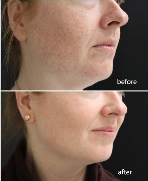 BBL laser pigmentation treatment before and after