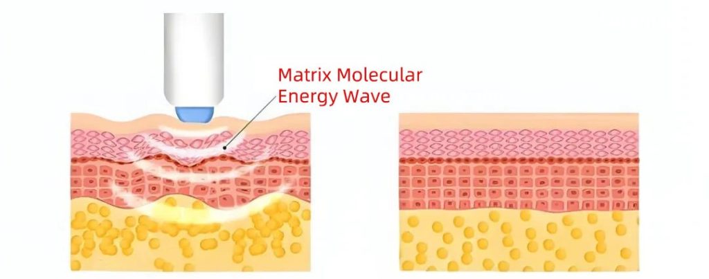 Thermage monopolar RF machine treatment schematic diagram