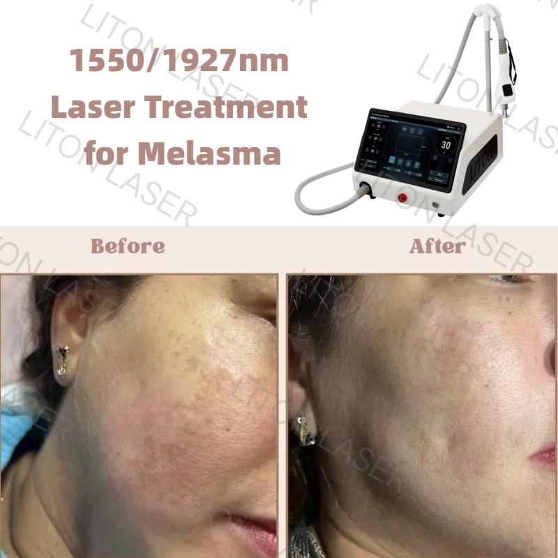 1550nm and 1927nm dual wave laser treatment of melasma before and after