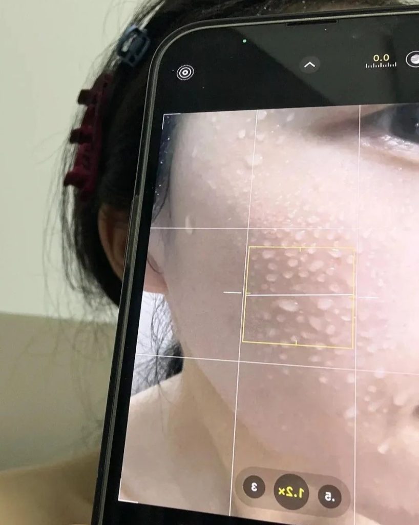 BBL laser 1 session skin treatment