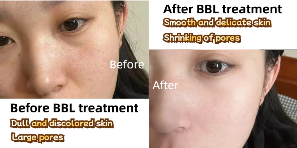 BBL laser before and after 4 treatments
