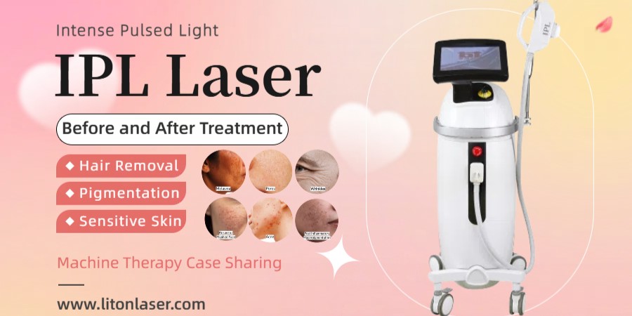 Before and After IPL Laser Treatment
