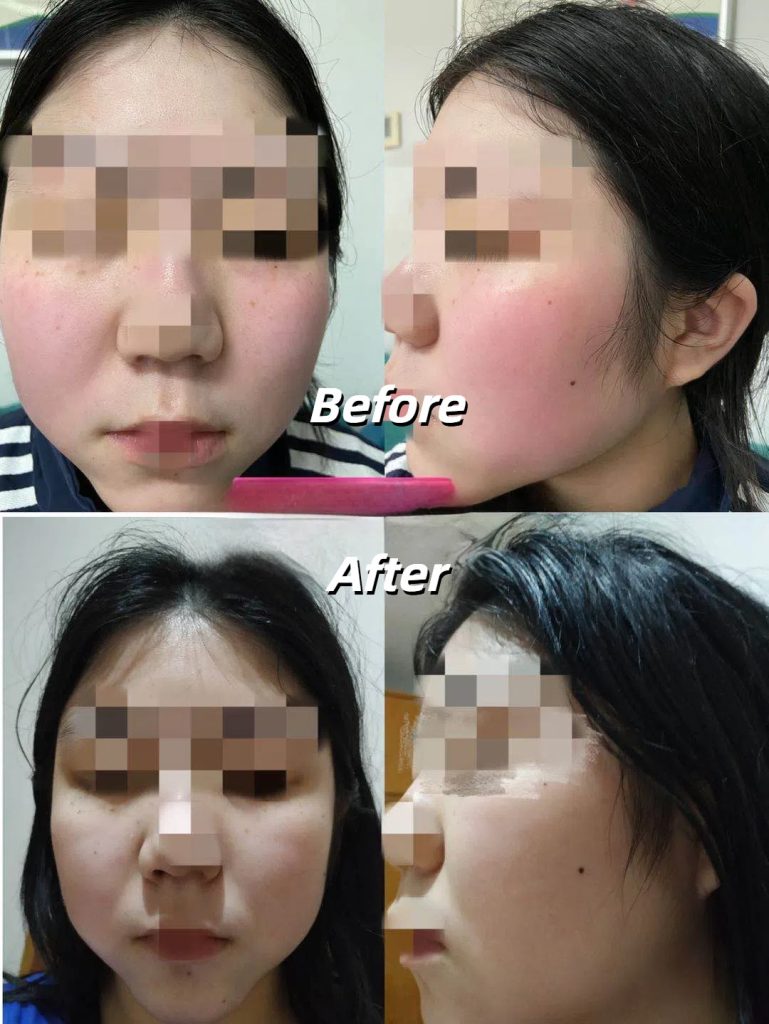 Before and after IPL laser treatment for sensitive skin