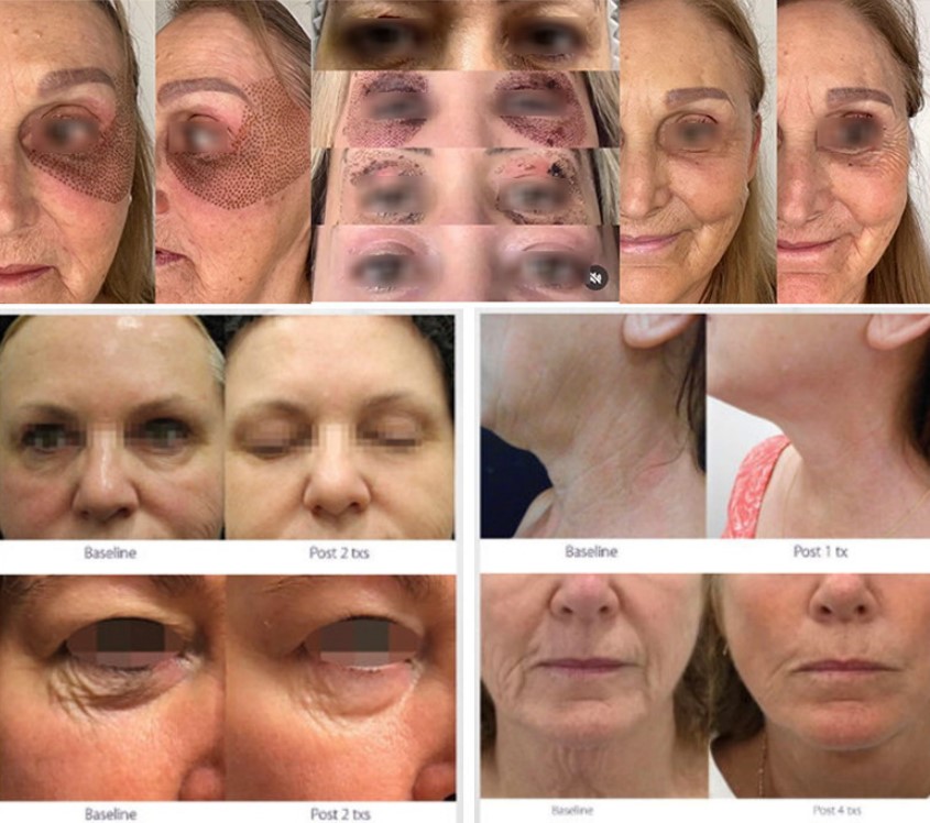 Before and after facial treatment with warm and cold fusion plasma device