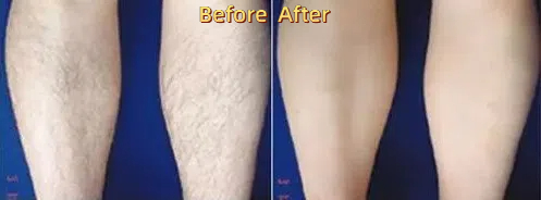 Diode laser leg hair removal before and after