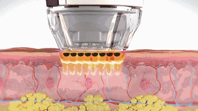 IPL Photorejuvenation Animation