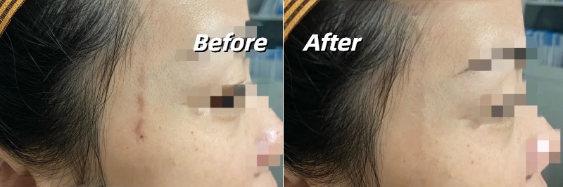 IPL laser pigmentation treatment before and after
