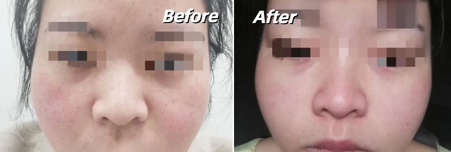 IPL laser treatment for freckles before and after