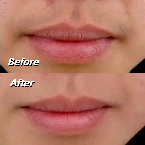 IPL laser upper lip hair removal before and after