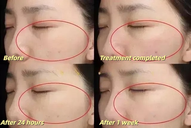 Pico laser treatment before and after