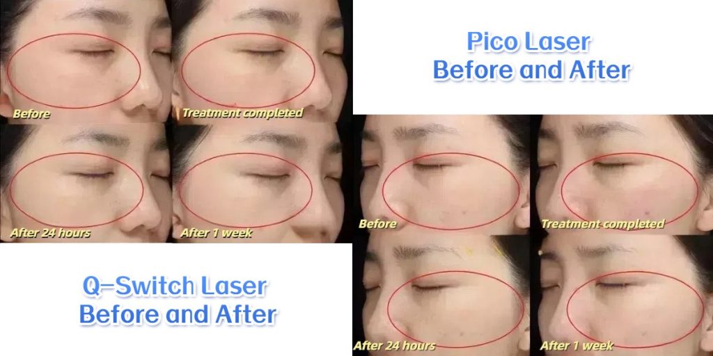 Pico laser vs Q-switch laser treatment before and after