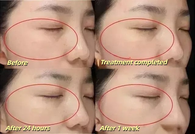 Q-switch laser treatment before and after