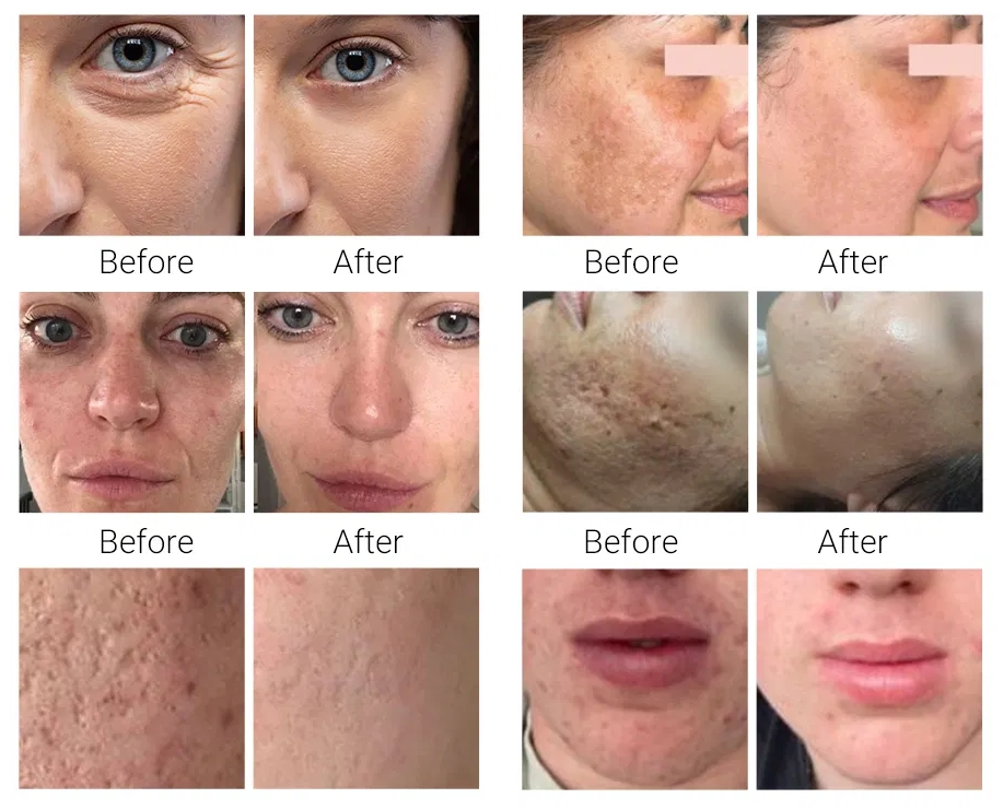 Hot and cold fusion plasma facial treatment before and after