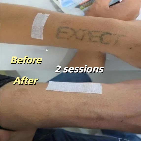 Before and after 2 sessions of Q switch laser tattoo removal