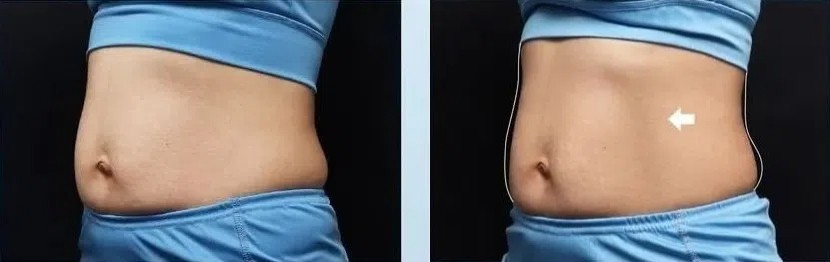 Emsculpt Neo Abdominal Muscle Building Before and After Picture